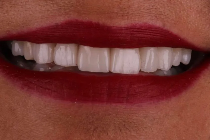 Sonrisa de la misma paciente después del tratamiento