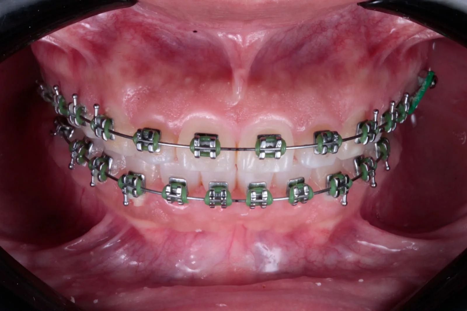 Brackets en un tratamiento de ortodoncia del consultorio